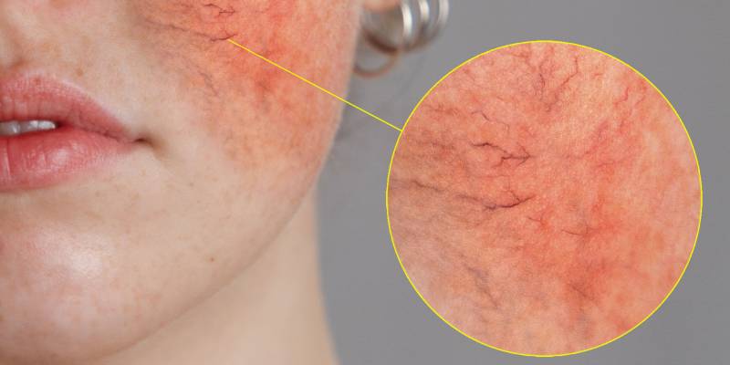 Gül Hastalığı Nedir (Pityriasis Rosea) Ve Tedavisi