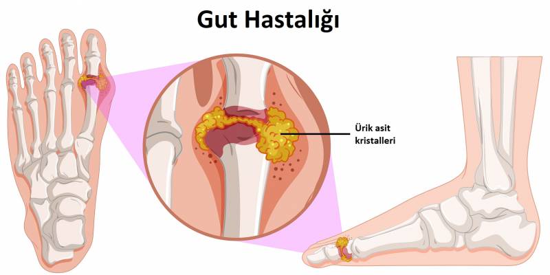 Gut hastalığının teşhis ve tedavisi Nasıl Yapılır?